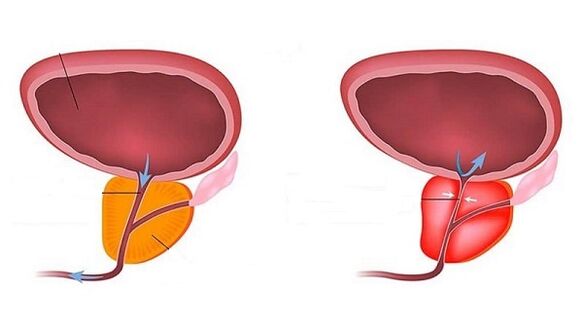 Prostate saine et enflammée avec prostatite