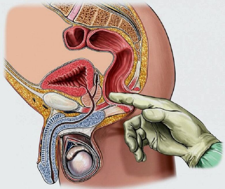 Massage de la prostate pour la prostatite