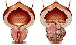 Prostate saine et malsaine